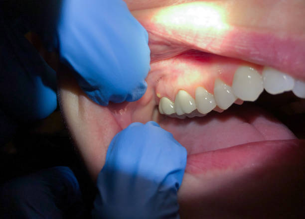 Best Emergency Care for Gum Disease in Port Ewen, NY