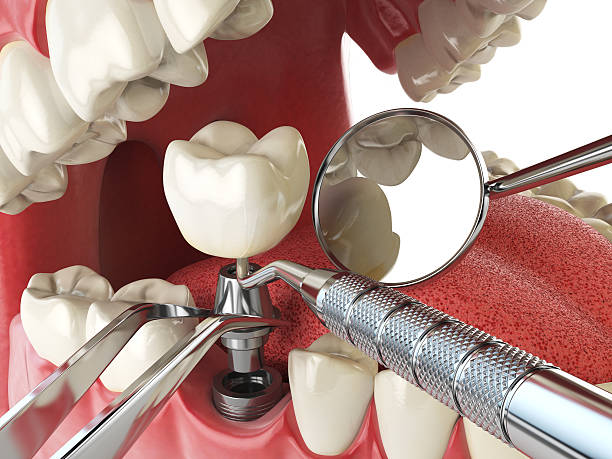 Best Emergency Root Canal Therapy in Port Ewen, NY